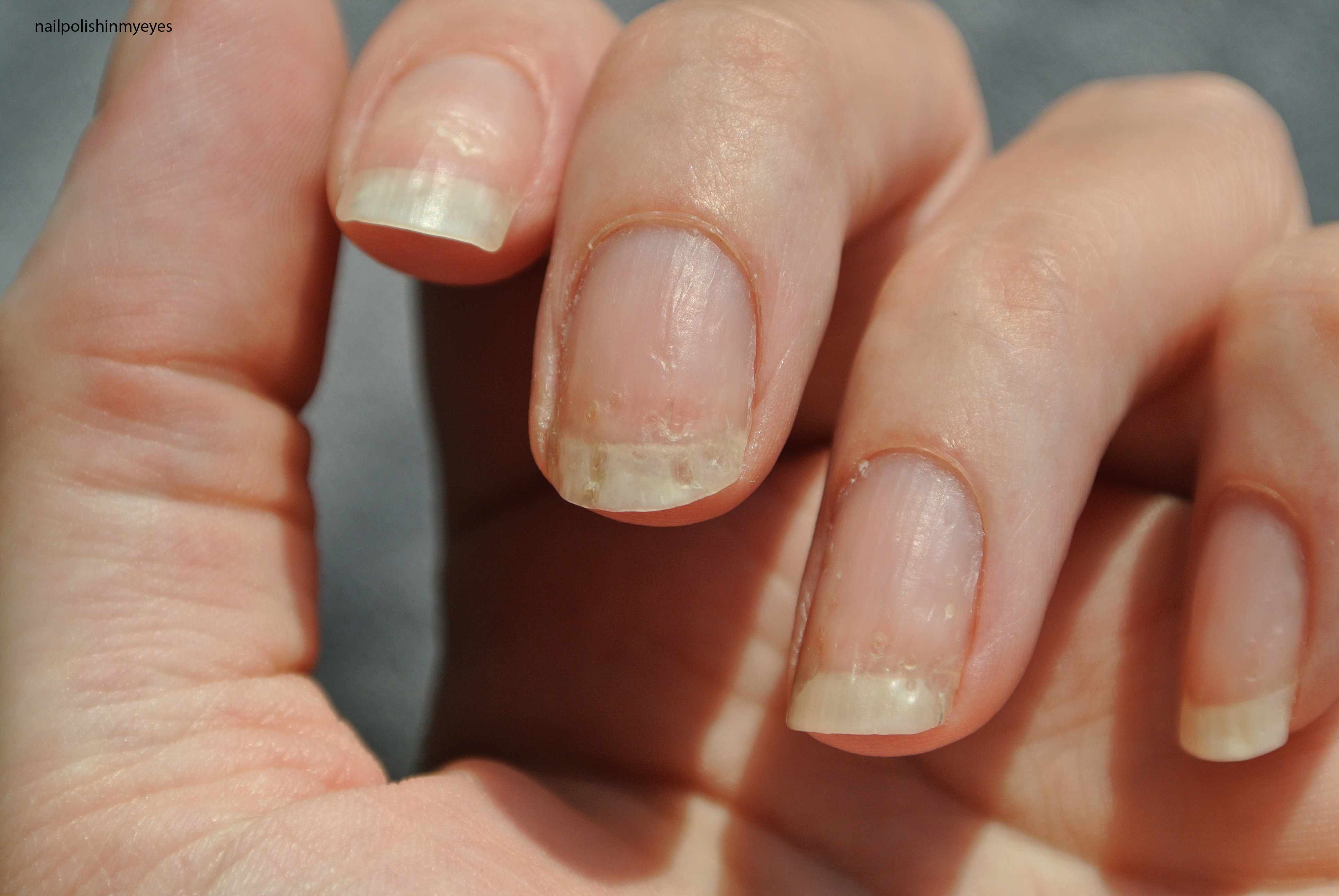 How eczema affected my nails… | Nail Polish in my Eyes