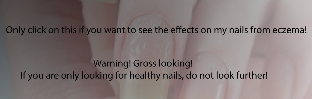How Eczema Affected My Nails… Nail Polish In My Eyes