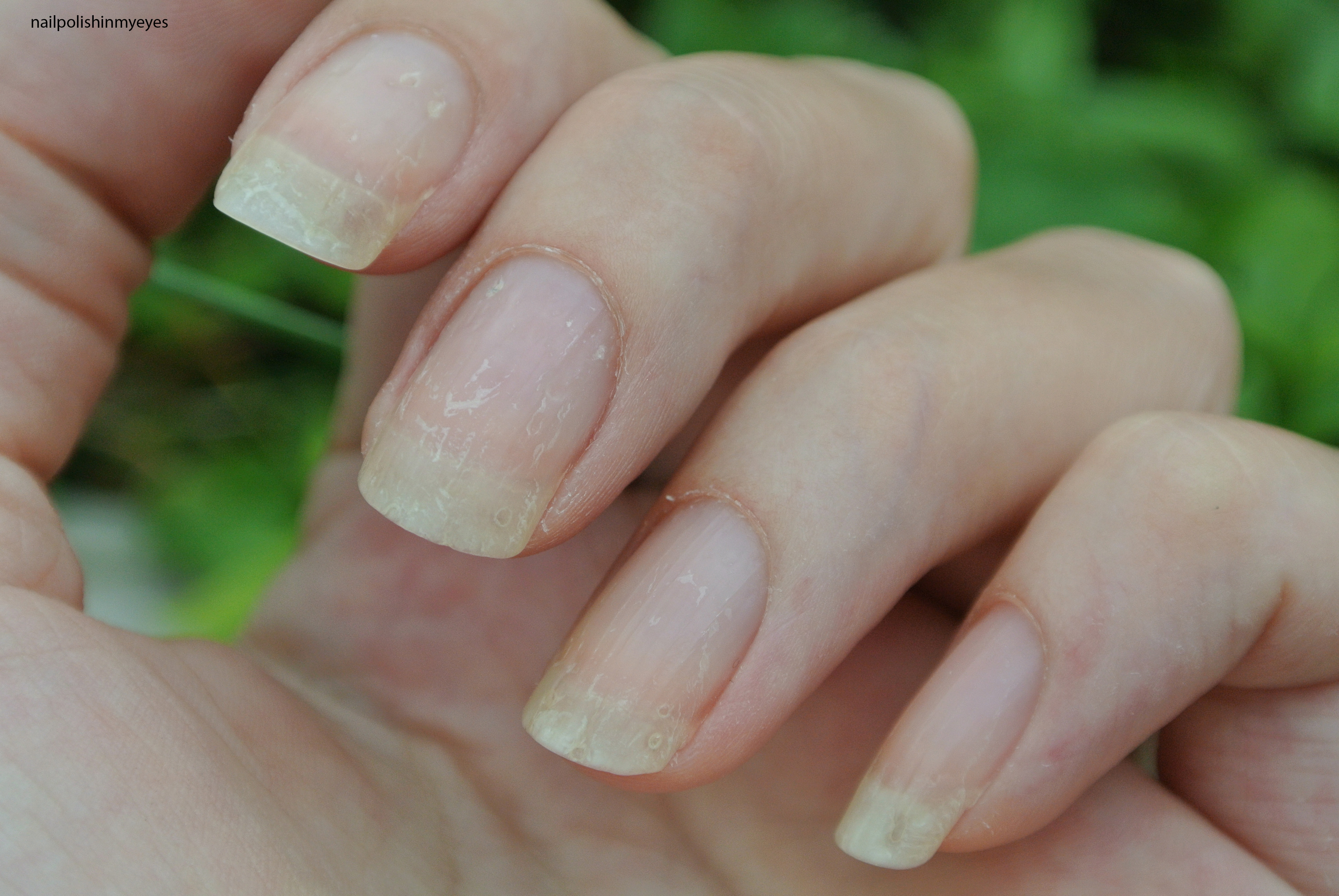 How Eczema Affected My Nails… Nail Polish In My Eyes